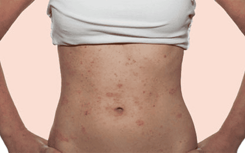 sai lầm mẹ cần tránh khi nịt bụng